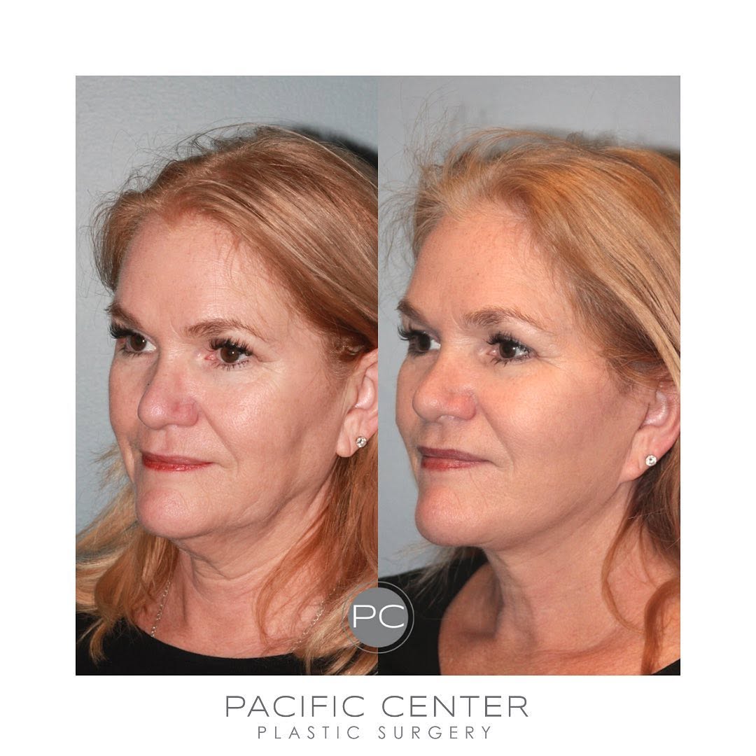Instagram post by Dr. Larry S. Nichter: Beautiful facial rejuvenation achieved under local anesthesia. We can combat signs of aging with improved, less-invasive techniques. Our pat…