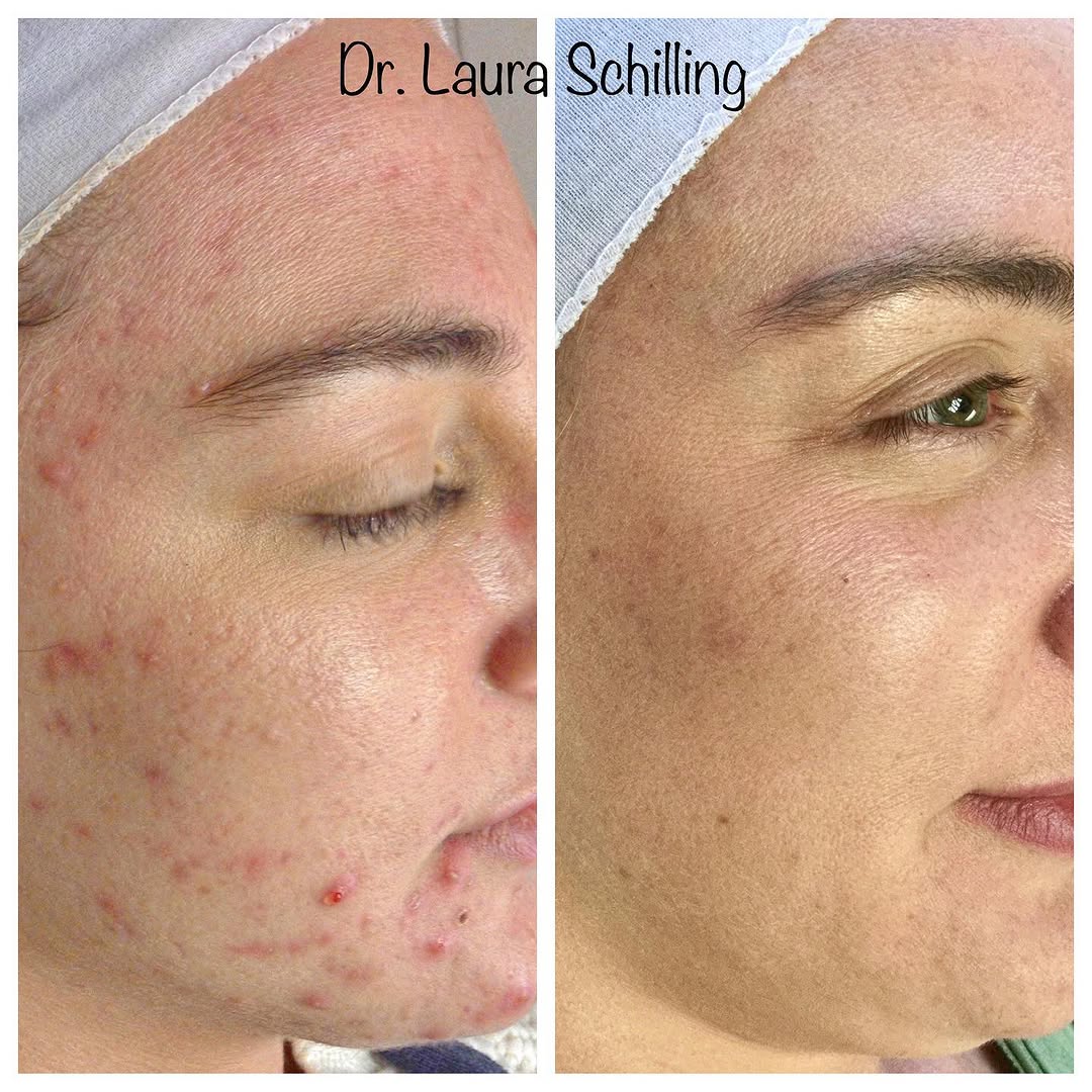 Instagram post by Dr. Laura Schilling: Acne is the “bread and butter” of dermatology, right?! Yes!...Acne is one of the most common complaints dermatologists see (in both teenager…