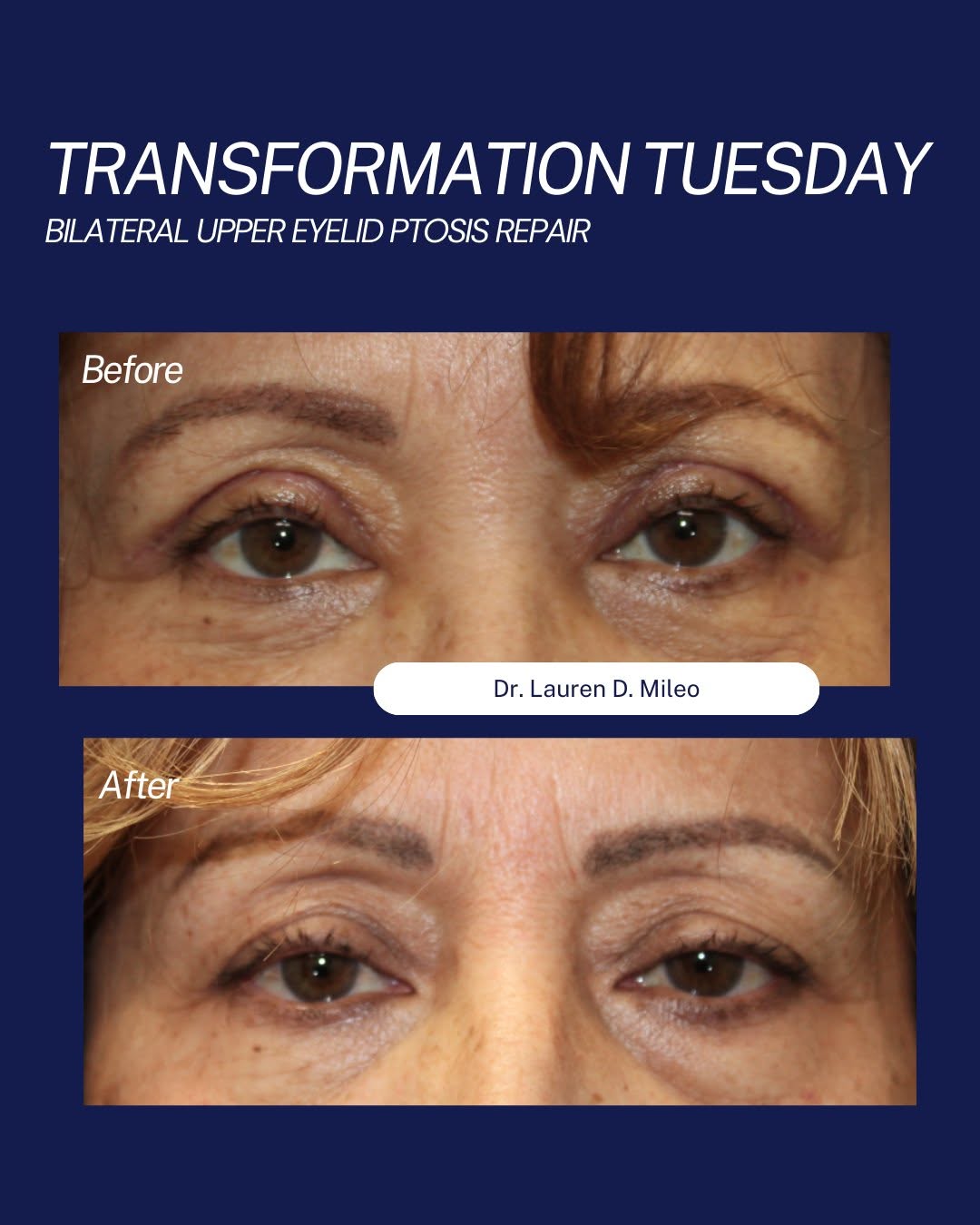 Instagram post by Dr. Lauren D. Mileo: ✨ Transformation Tuesday ✨ A small lift can make a big difference. This week, we're highlighting a patient of Lauren Mileo, MD who underwent…