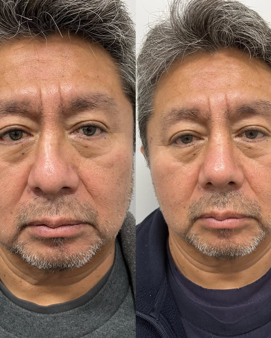 Instagram post by Dr. Laurence M. Milgrim: Fixing a twisted nose is the most challenging of procedures in facial plastic surgery. It involves understanding how each part of the nose f…