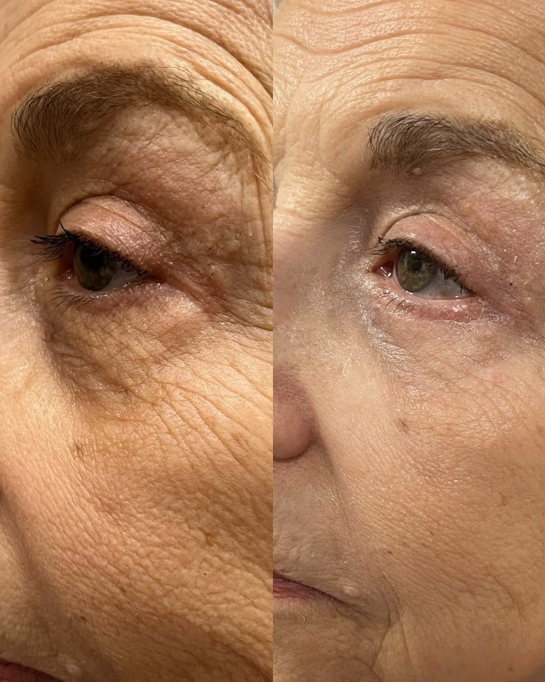 Instagram post by Dr. Laurence M. Milgrim: Lower eyelid surgery can make a real difference in someone’s appearance, especially in the aging patient. In this patient, she had both fat …