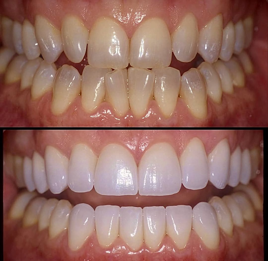 Instagram post by Dr. Laurence Rifkin: Do you want healthy gum, tissue, or pretty teeth? How about both…always! Precision dentistry equals healthy gum tissue. 10 upper and six low…