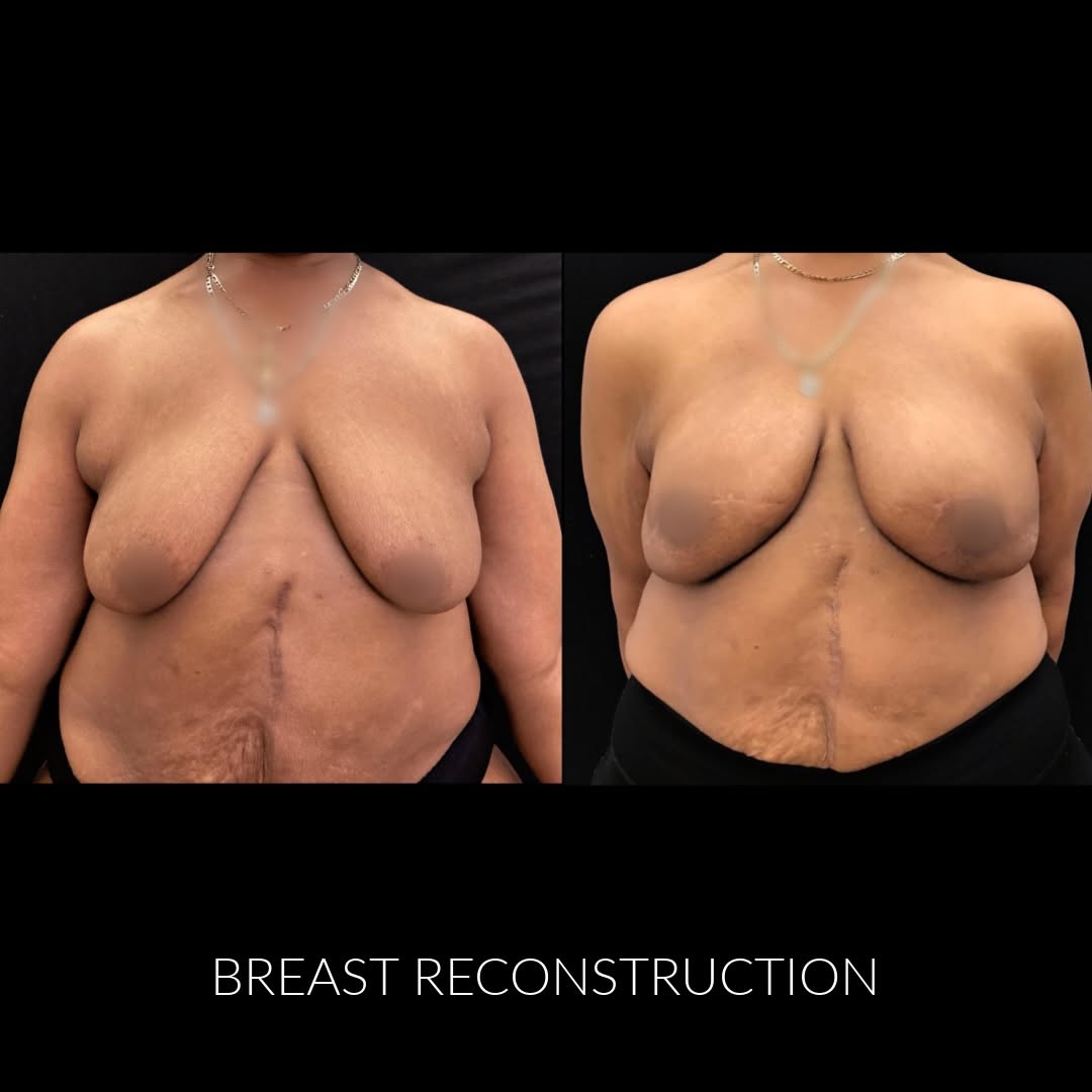 Instagram post by Dr. Lawrence D. Chang: Look at this amazing 60yo who is now 4 months after double nipple sparing mastectomy with 2nd staged implant based reconstruction #breastcan…