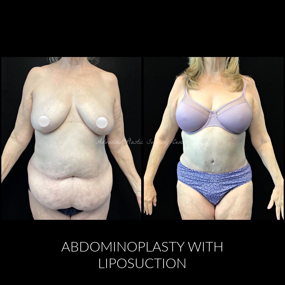 Instagram post by Dr. Lawrence D. Chang: Amazing results 3 months post-op by Dr. Lawrence Chang! Patient underwent an Abdominoplasty with Liposuction to abdomen, flanks, bra fat and…