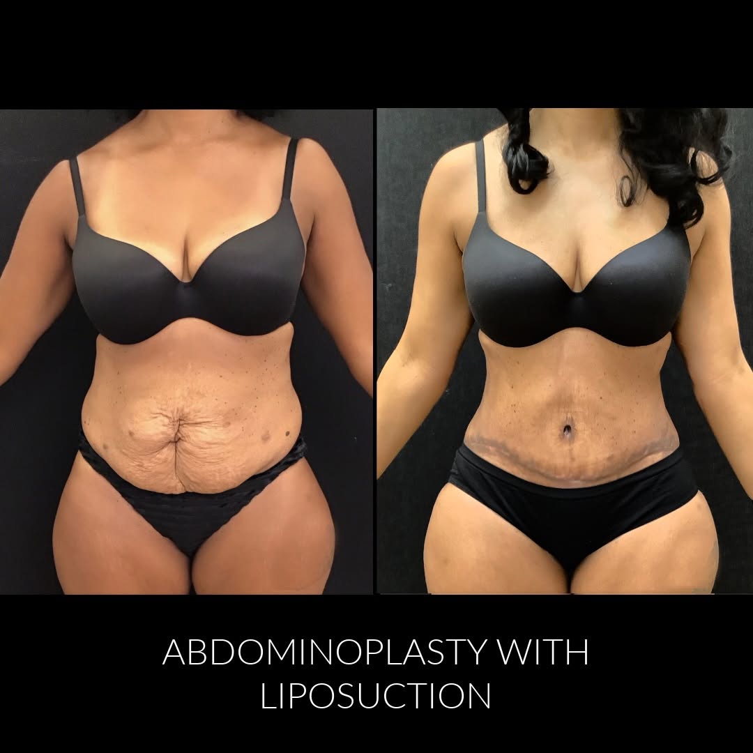 Instagram post by Dr. Lawrence D. Chang: Body transformation 💫 This patient is 8 weeks post op after Abdominoplasty with muscle tightening and liposuction. She is happy with her re…