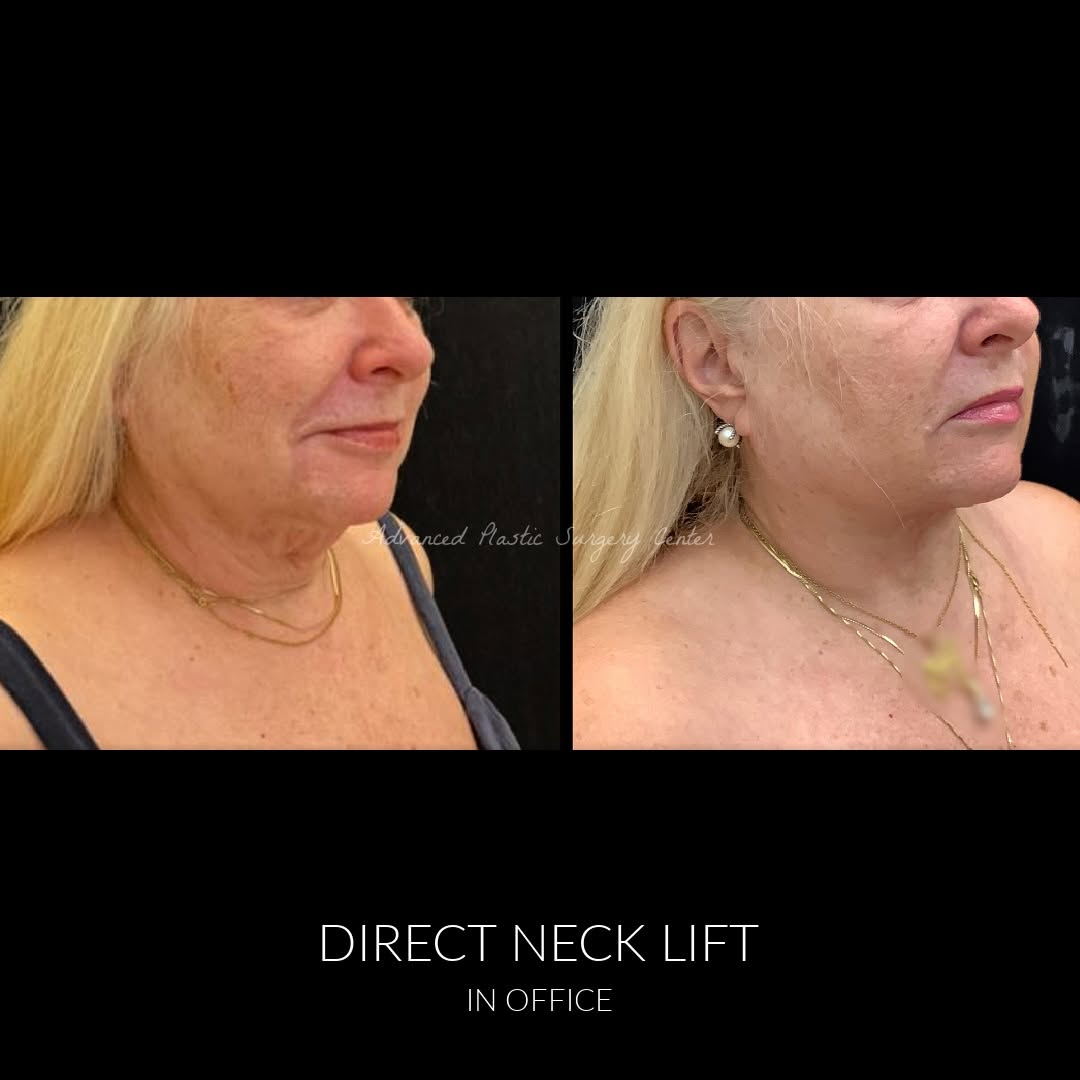 Instagram post by Dr. Lawrence D. Chang: Amazing 4 months post op results after our patient had an in office direct excision neck lift with z-plasty by Dr. Chang 👏🏼 She is very ha…