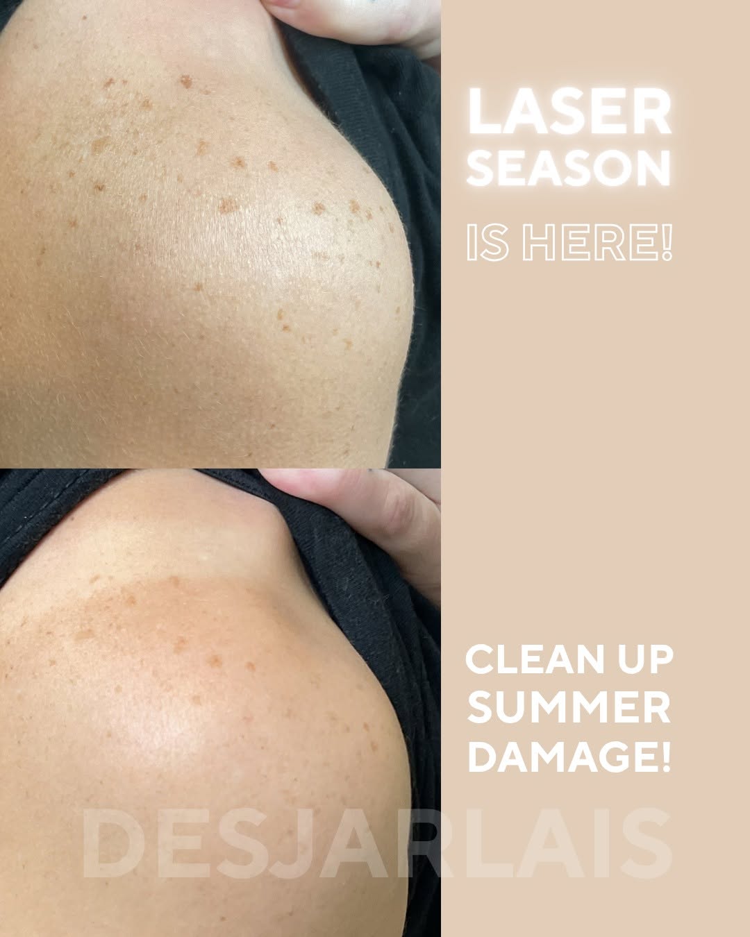 Instagram post by Dr. Lawrence Desjarlais: ☀️ SUMMER SUN SHOWS UP ON YOUR SKIN. Spots, uneven tone, and changes in texture can be the not-so-fun souvenirs of summer. 🍂 Fall is the pe…