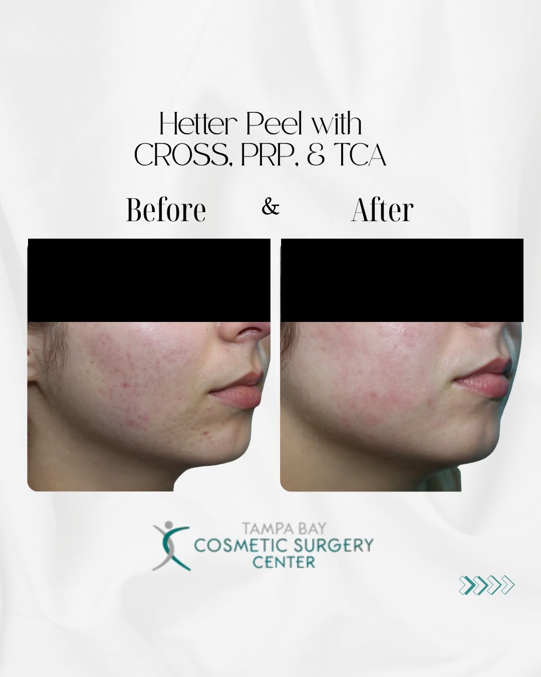 Instagram post by Dr. Lawrence Kass: Acne scarring can affect more than skin, it affects confidence. This patient came to Dr. Kass wanting a smoother, more even complexion after…