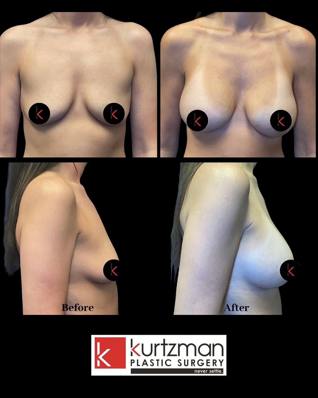Instagram post by Dr. Lawrence Kurtzman: ✨Size | 500cc Beautiful transformation by Dr. Kurtzman — this patient’s results were achieved with 500cc implants for a fuller, balanced sil…