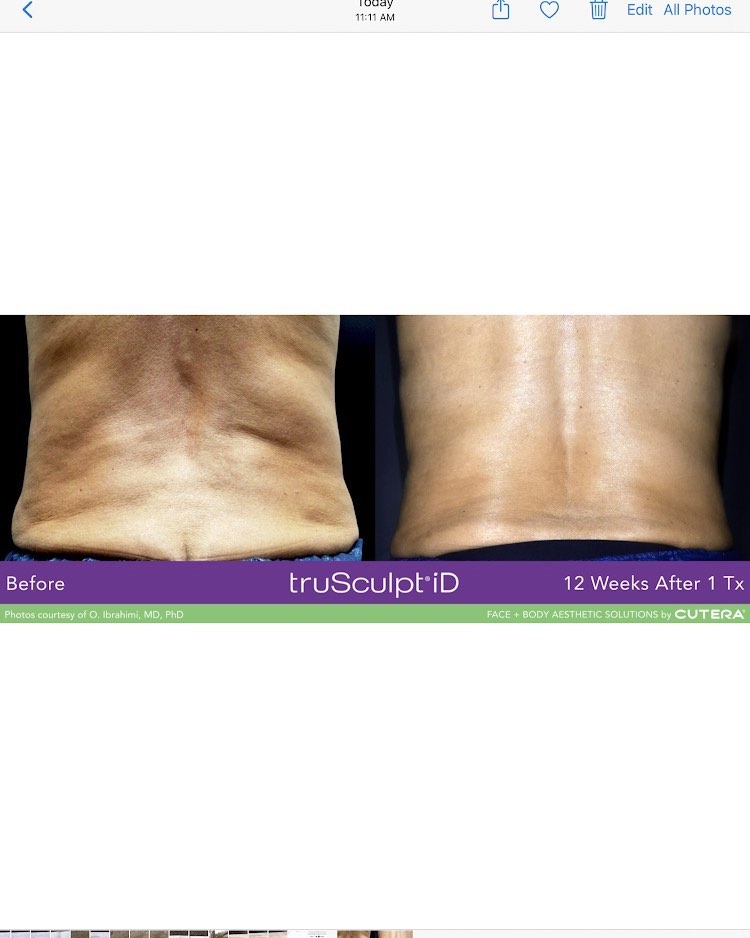 Instagram post by Dr. Lawrence Matt: Thinking of the beach? Check these photos before and after ONE treatment truSculpt iD