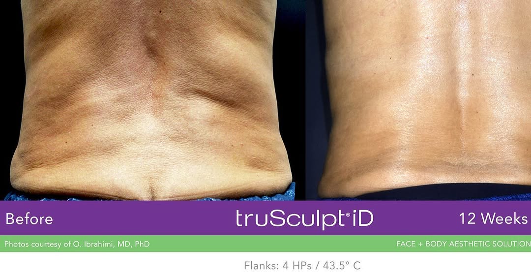 Instagram post by Dr. Lawrence Matt: Check out this great result after just ONE tru-Sculpt iD treatment!
