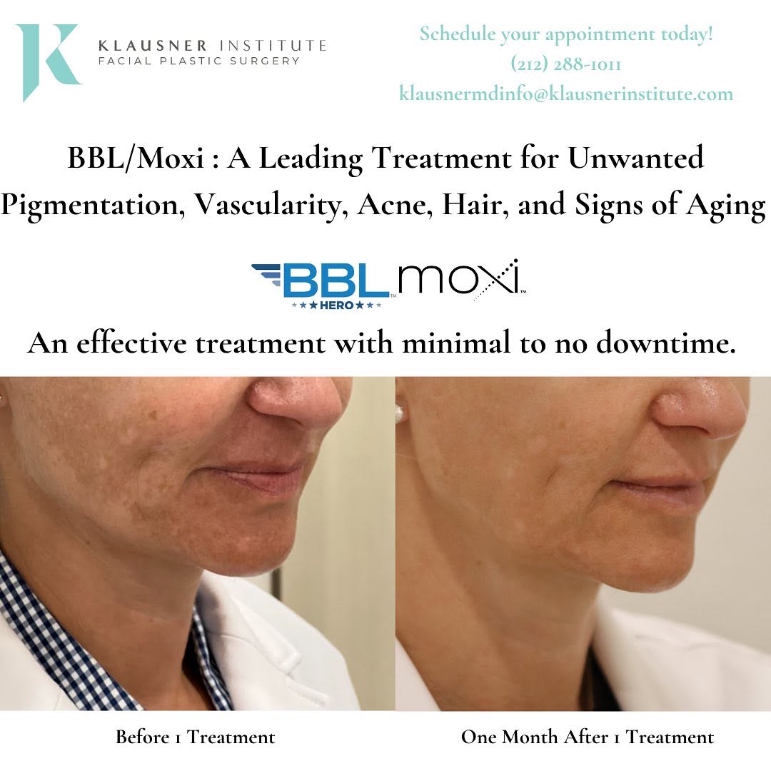 Instagram post by Dr. Lee Ann M. Klausner: Melasma is a common skin condition characterized by large pigmented patches on the skin. Melasma is caused by an overproduction of melanin d…