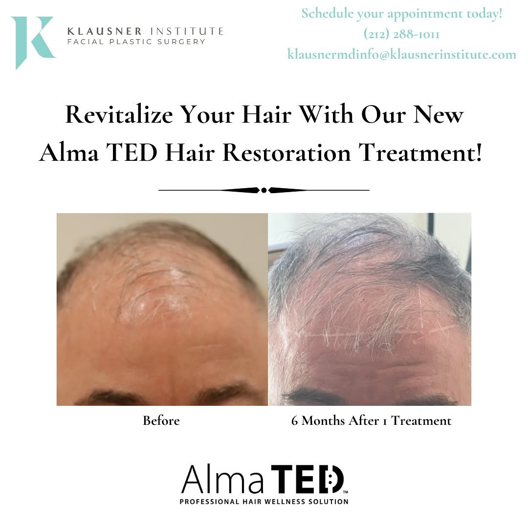 Instagram post by Dr. Lee Ann M. Klausner: Revitalize your hair with Alma TED - a non-invasive treatment promoting healthy new hair growth. Call or email us to schedule your consultat…