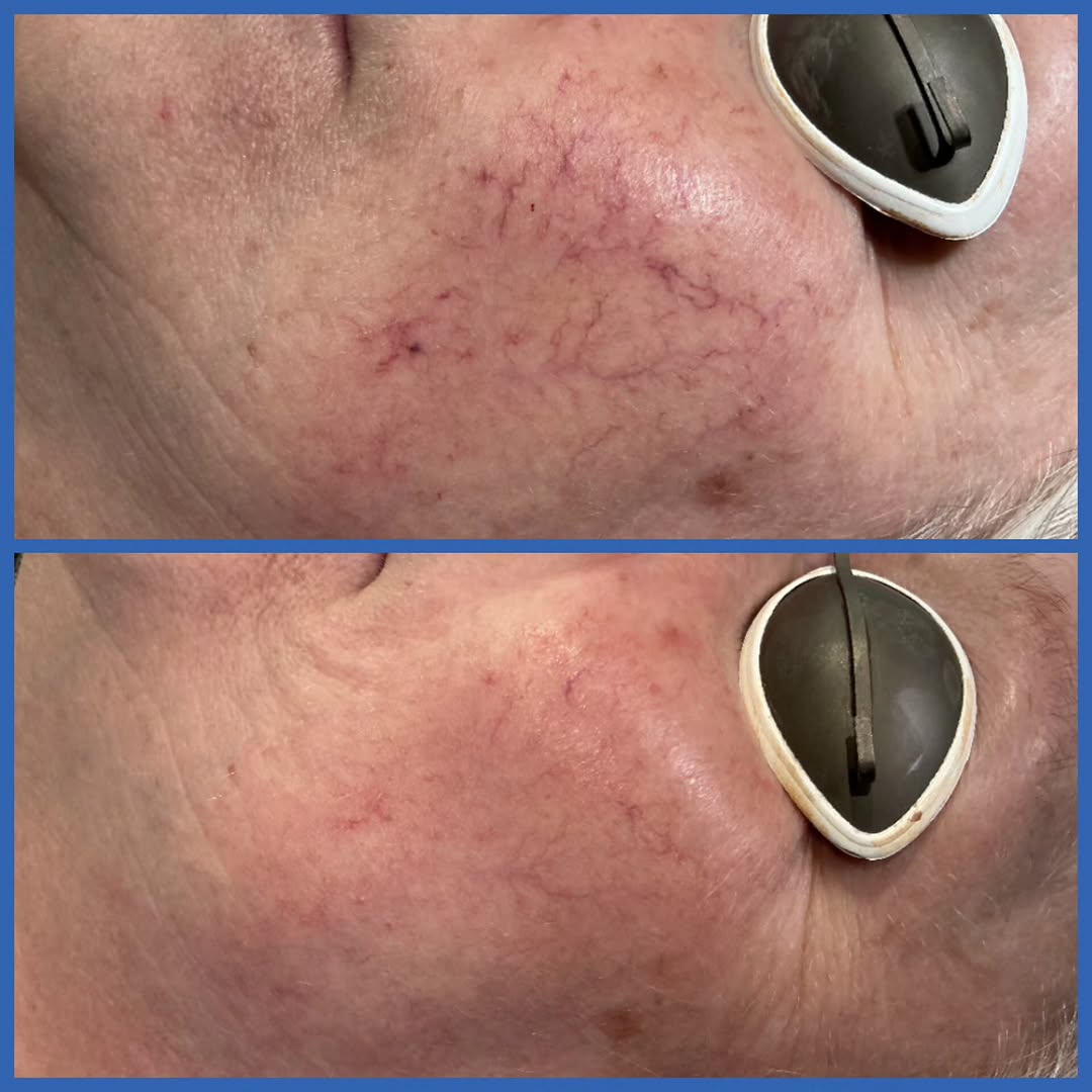 Instagram post by Dr. Lee B. Daniel: ✨ REDNESS, MEET YOUR MATCH ✨ If you deal with visible capillaries, flushing, or rosacea — the Vbeam Perfecta laser might be your new best fr…