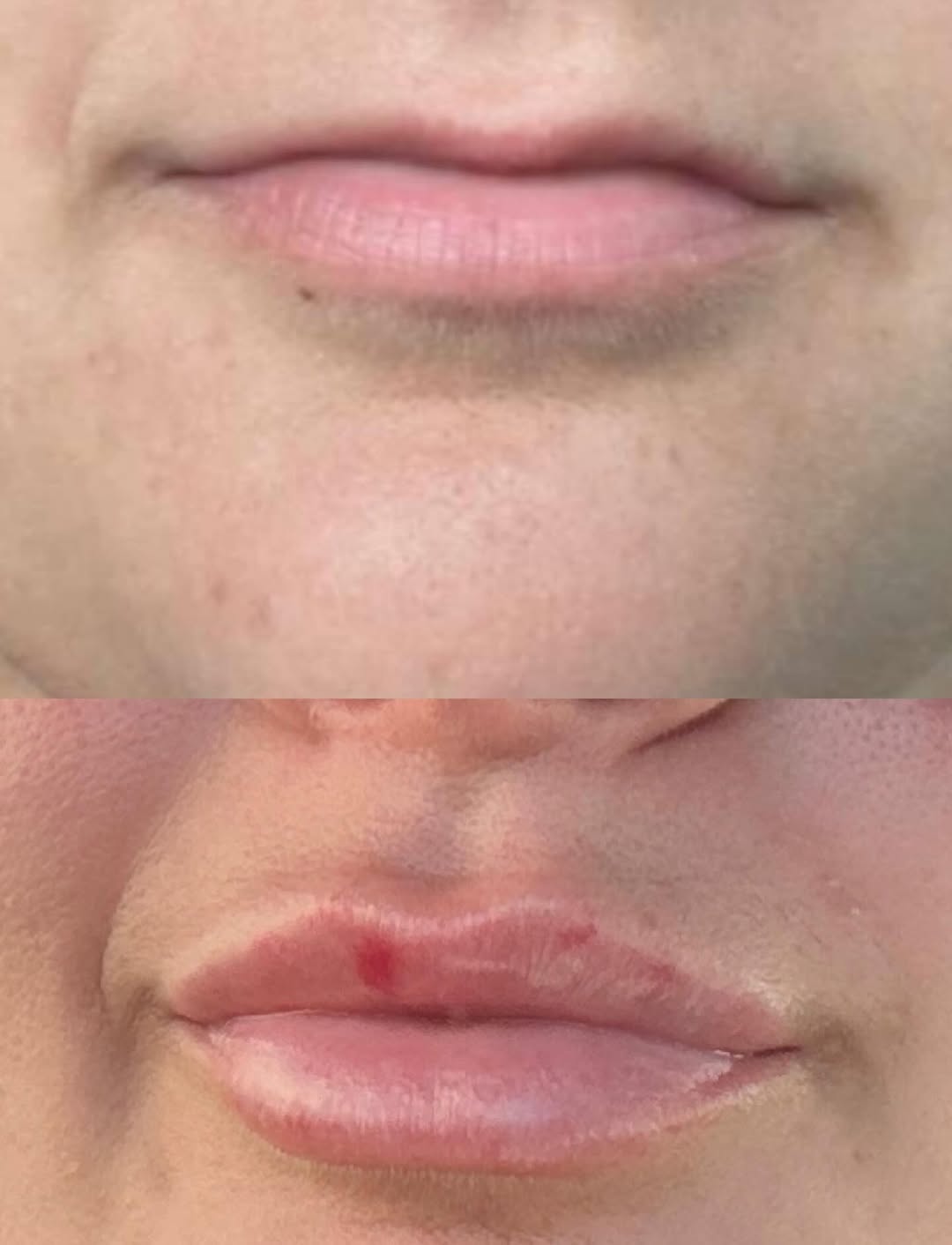 Instagram post by Dr. Leila S. Grayson: YOU GUYS🤯 • YES this is the same person. YES it’s possible to have the lips of your dreams if you TRUST THE PROCESS. Slow and steady does i…