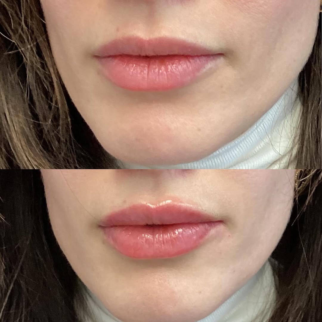 Instagram post by Dr. Leila S. Grayson: Natural lip filler is DEFINITELY coming with us in 2026 👄🤌🏻 ••••••••••••••••••••••••••••••• 👩🏻⚕️Cristina Imburgia, FNP-BC 📞Call to Bo…
