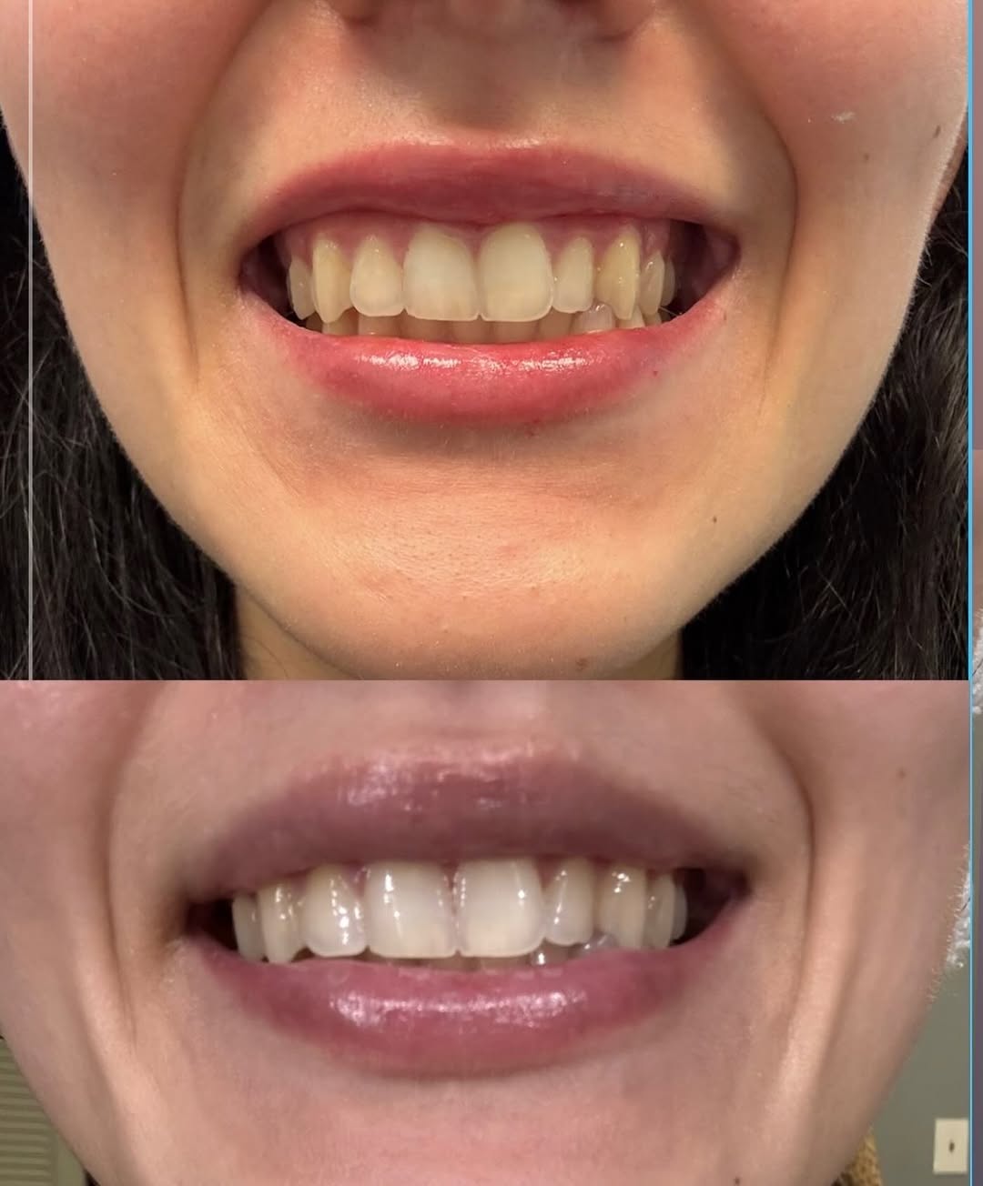 Instagram post by Dr. Leila S. Grayson: Lip Flip of my DREAMS!!!! ✨☁️👄 • What it IS: A lip flip is achieved by injecting neurotoxin above the top lip in the Orbicularis Oris muscl…