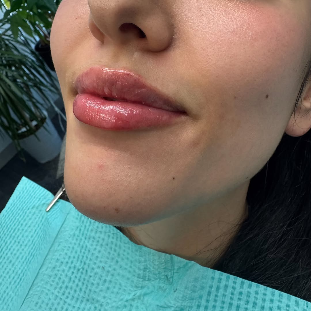 Instagram post by Dr. Leila S. Grayson: Fresh off the needle 💉 • These were just too gooooooooood 💦👄 • First- timer with 0.6cc @revanesseusa Versa Lips