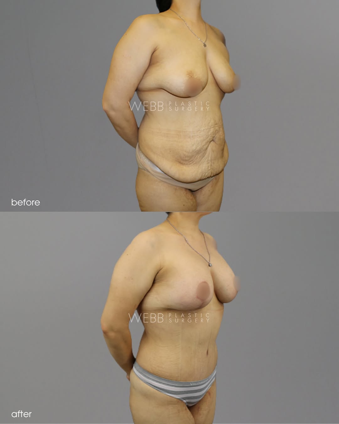 Instagram post by Dr. Leland Webb: A mommy makeover is completely personalized to your body and your goals, whether that means addressing changes to the breasts, abdomen, or b…