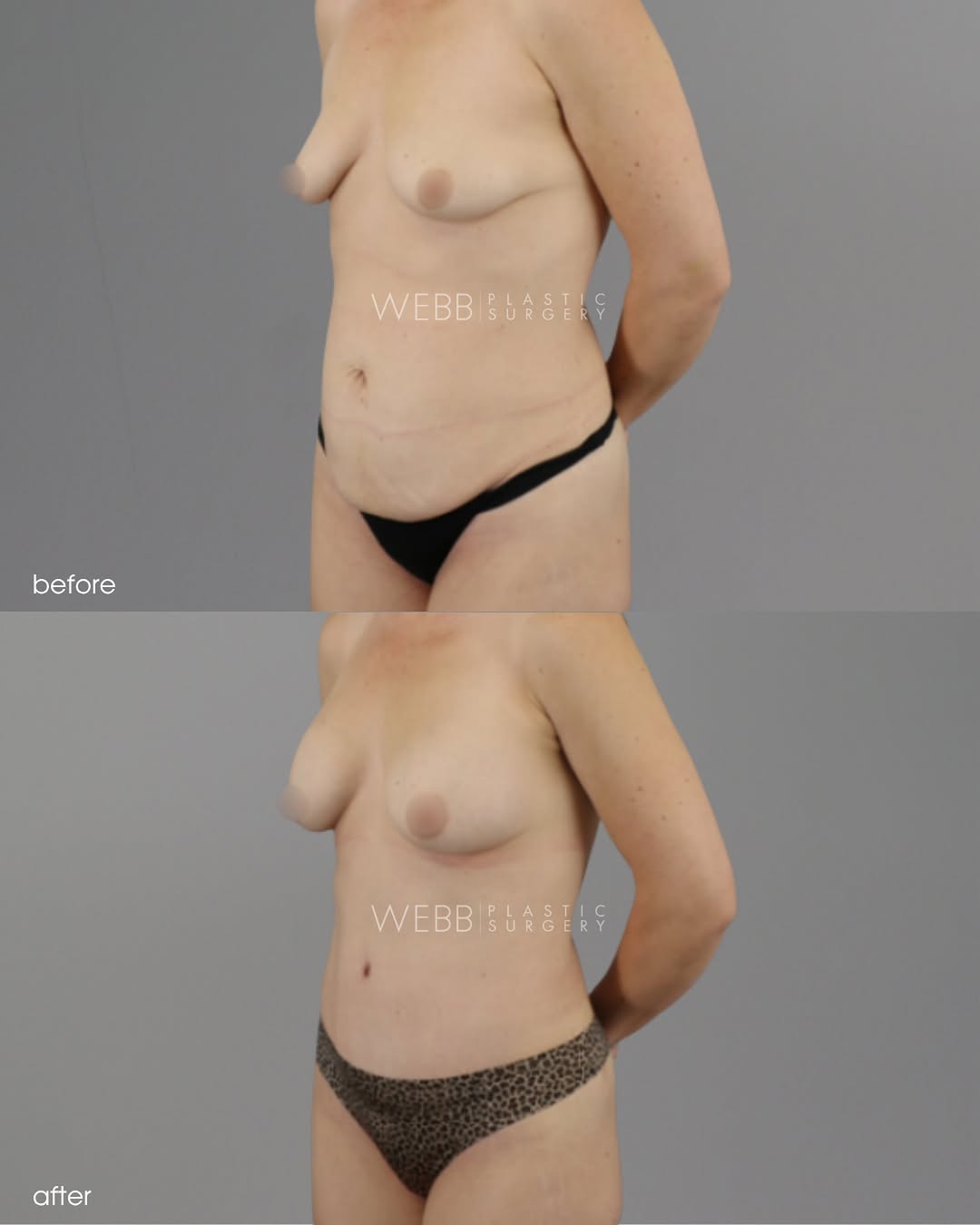 Instagram post by Dr. Leland Webb: Mommy Makeover Monday 🤎 This Mommy Makeover before & after is a glimpse of what’s possible when your procedure is thoughtfully tailored to …