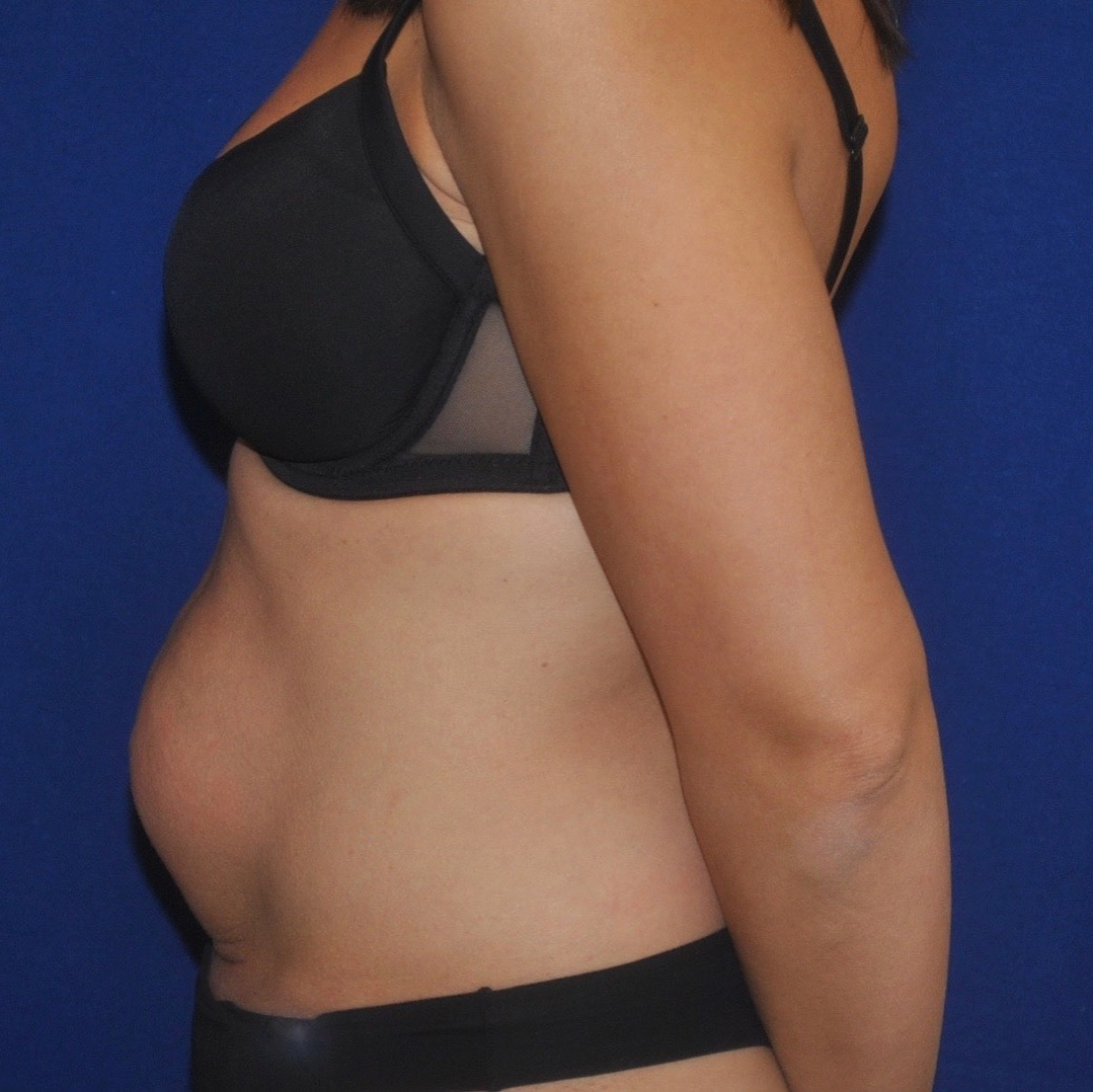 Instagram post by Dr. Leo Keegan: Get ready for your best summer self! #drleokeegan #abdominoplasty #tummytuck #plasticsurgerynyc #beautyyoucanbelievein