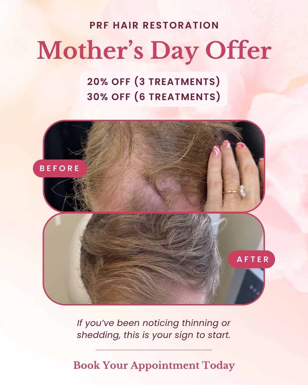 Instagram post by Dr. Leonard W. Gray: Give the gift of confidence this Mother’s Day 🌸 PRF Hair Restoration uses your body’s own growth factors to support stronger, healthier hai…