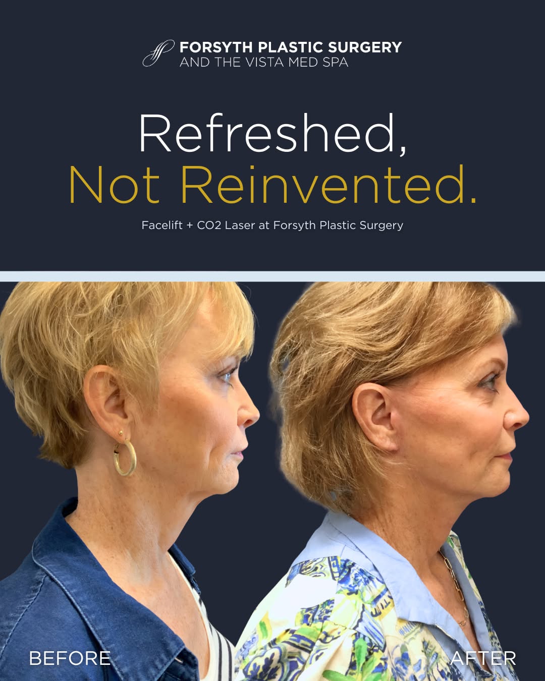 Instagram post by Dr. Leslie G. Branch: This is what "refreshed, not reinvented" actually looks like. ✨ A facelift at Forsyth Plastic Surgery is designed to restore firmness and co…