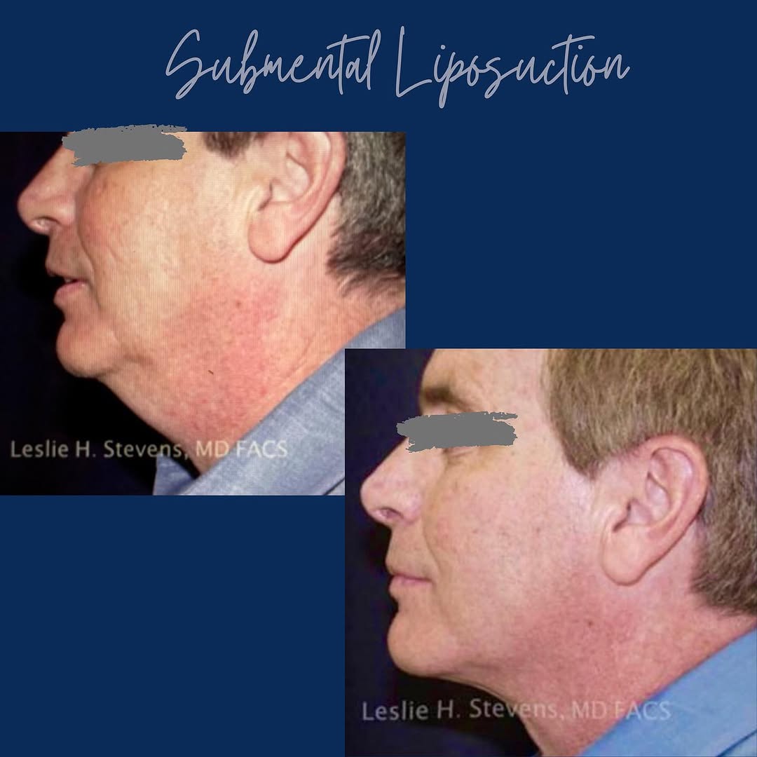 Instagram post by Dr. Leslie H. Stevens: Submental Liposuction or Chin & Jawline Sculpting is a surprisingly easy way to improve one’s profile. Despite that a traditional Neck Lift …