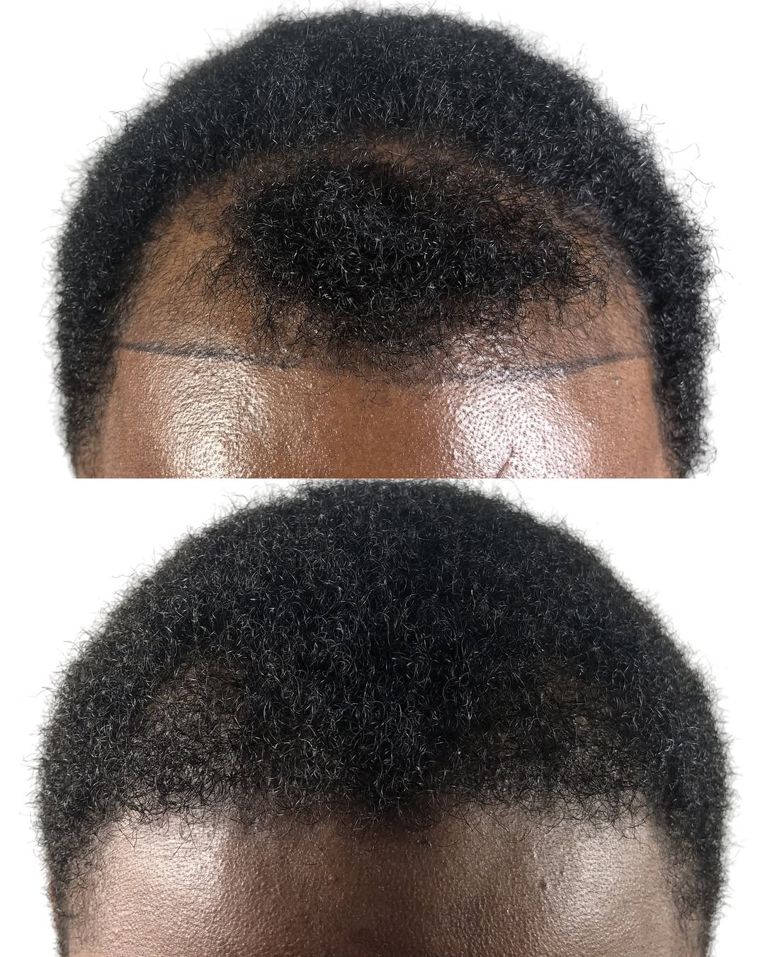 Instagram post by Dr. Leslie Pickens: In just six months, what was once a completely bald and receding hairline has transformed into a fuller, more defined one. The new hair from…