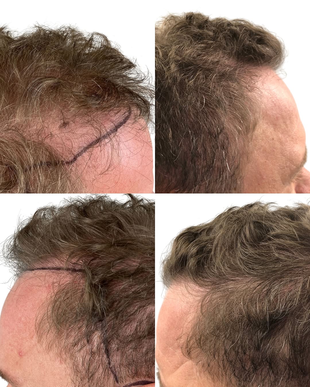 Instagram post by Dr. Leslie Pickens: Six months in and the difference is already clear. With 2,651 FUE grafts, the hairline looks fuller, stronger, and more natural from every a…