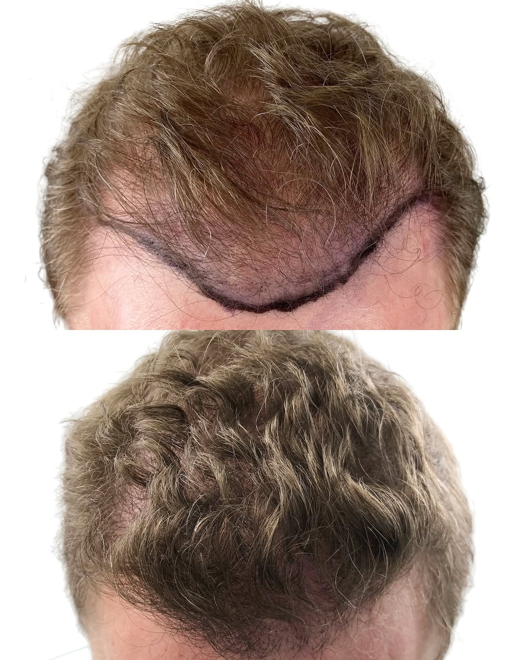 Instagram post by Dr. Leslie Pickens: Now you see thinning hair. Now you don’t. The right hair transplant can solve that issue and completely transform your look.
