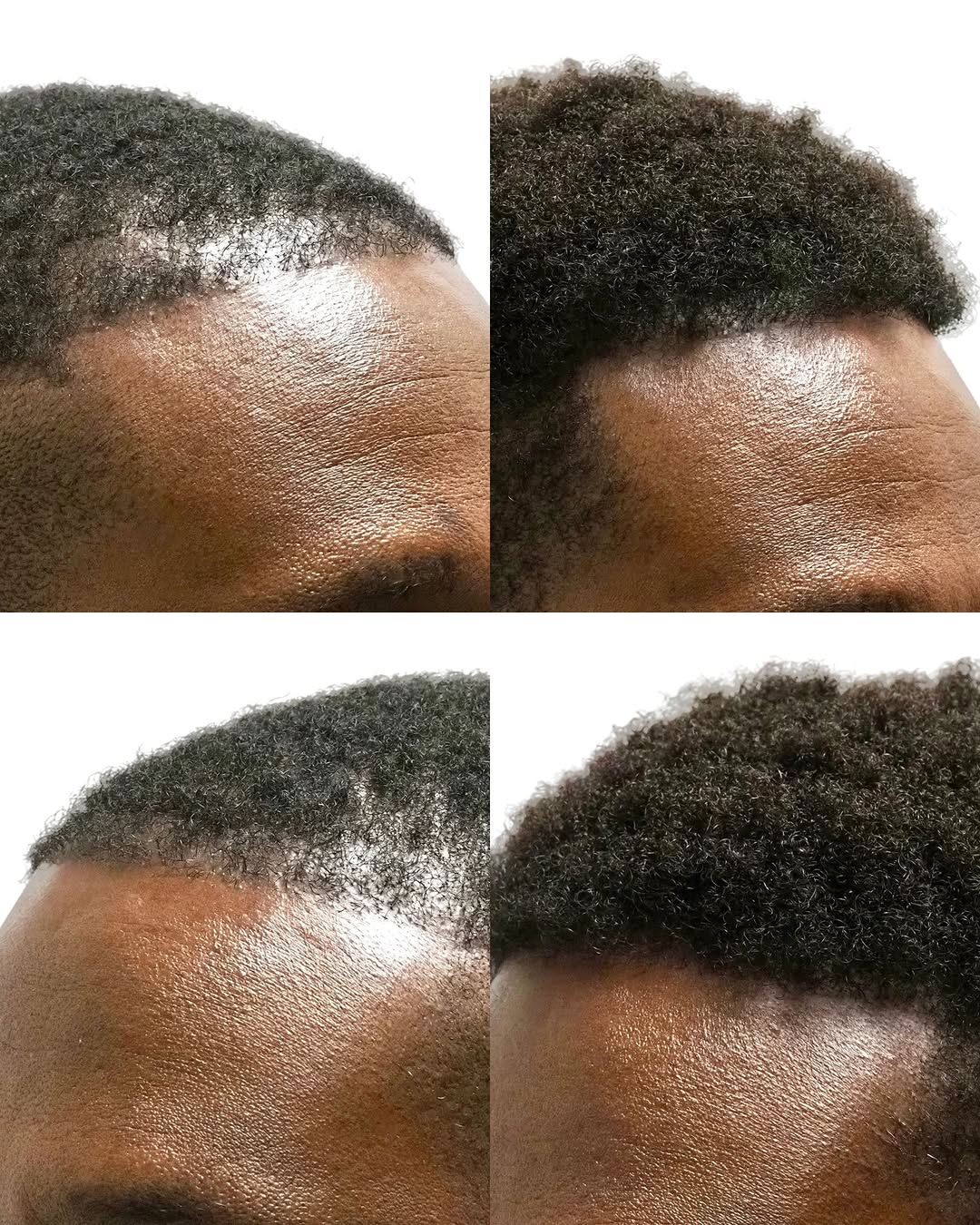Instagram post by Dr. Leslie Pickens: A fuller hairline, stronger density, and more even coverage can completely change the way the hair looks from every angle.