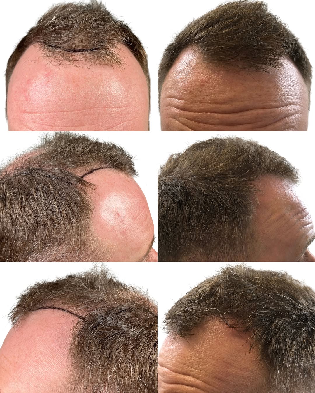 Instagram post by Dr. Leslie Pickens: Filling in the hairline and crown can have a major impact on your overall profile. These areas shape how your hair looks from the front, sid…