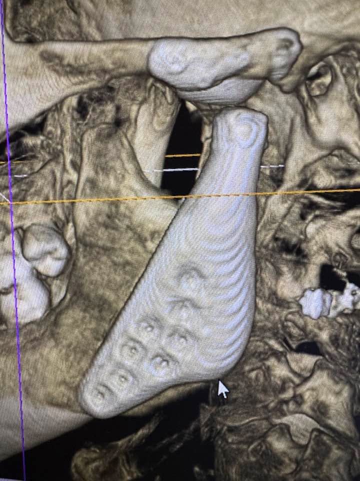 Instagram post by Dr. Leslie Sultan: Combined orthognathic/TMJ replacement for facial asymmetry caused by bony ankylosis. 5 year postop. Very satisfying result for patient and s…