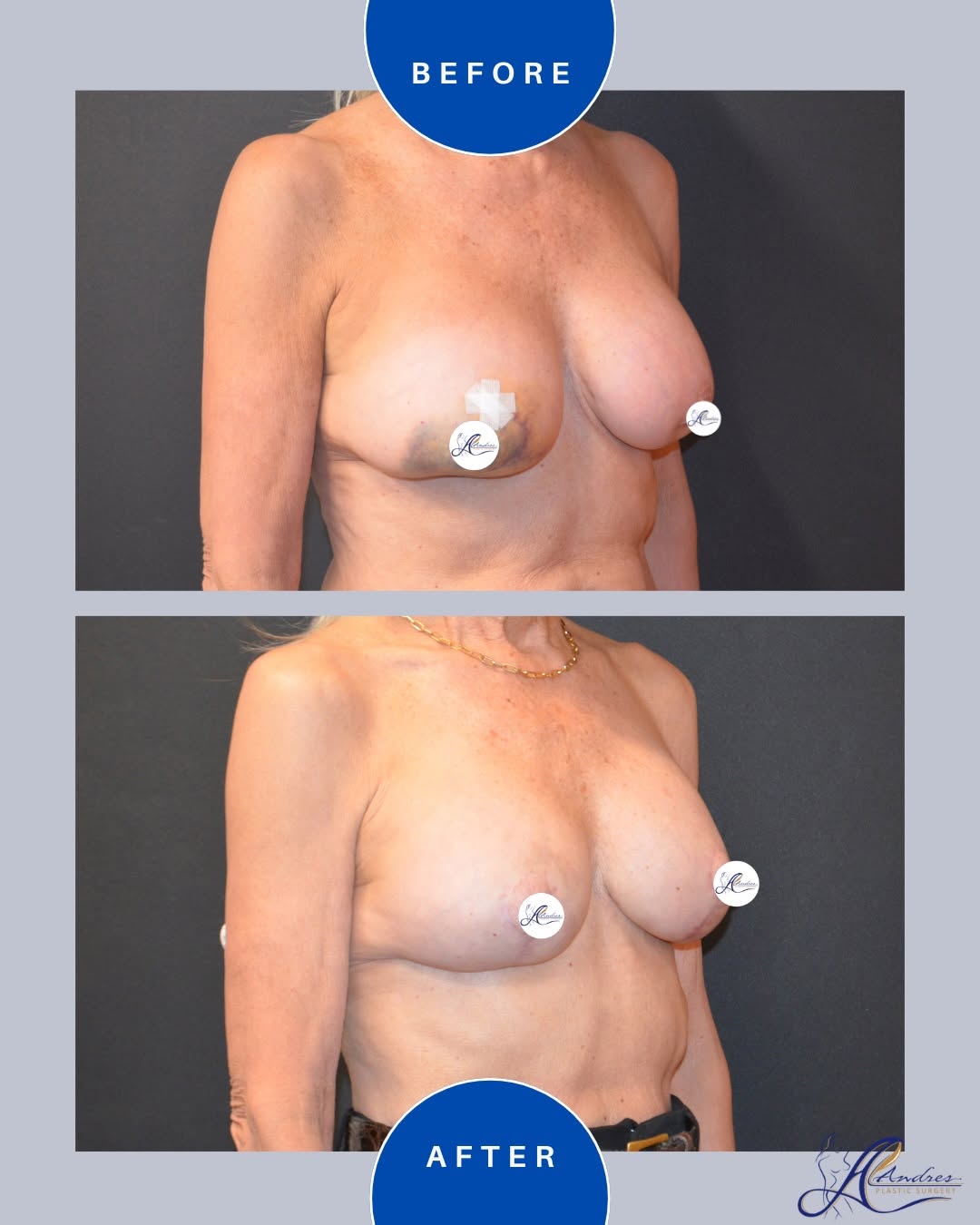 Instagram post by Dr. Lewis Albert Andres: ✨ Revision Implant Exchange & Breast Lift ✨ This patient came to Dr. Andres after discovering her breast implants had ruptured following a b…