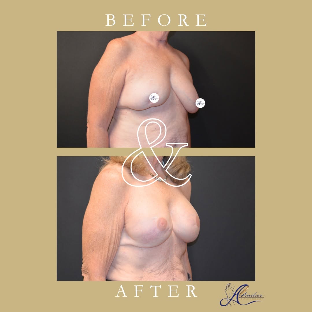 Instagram post by Dr. Lewis Albert Andres: This patient’s breast cancer journey began with a lumpectomy, but over time she desired improved breast shape, symmetry, and a more natural …