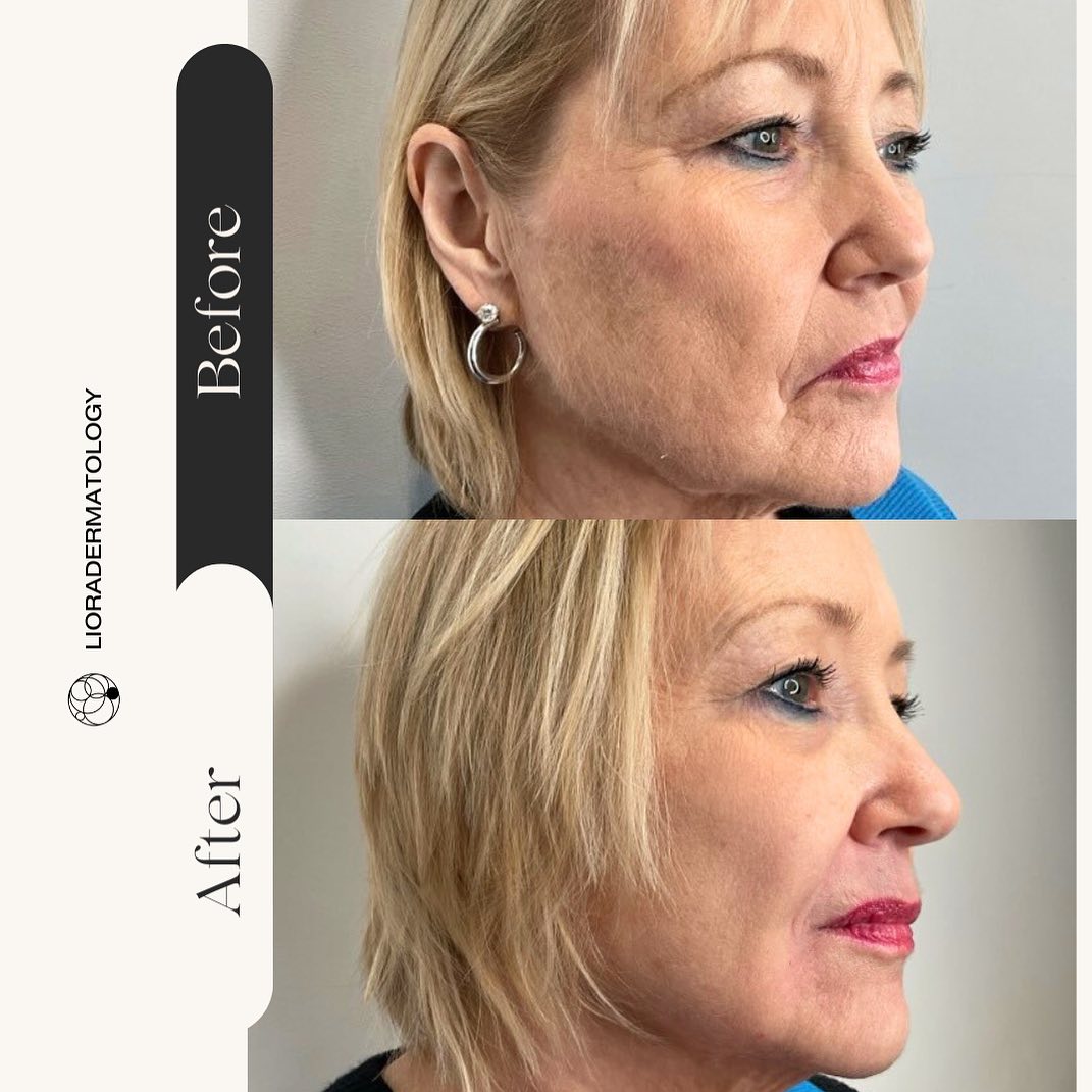 Instagram post by Dr. Libby Rhee: Natural results 📐 Many people fear filler and looking over-filled. Rest assured, here at Liora our focus is on mastering natural results th…