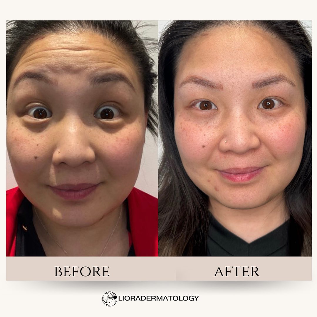 Instagram post by Dr. Libby Rhee: From Fine Lines to FABULOUS! 💉✨ Say goodbye to those pesky fine lines and HELLO to smoother rejuvenated look with Botox ☀️ PLUS THIS MAY ON…