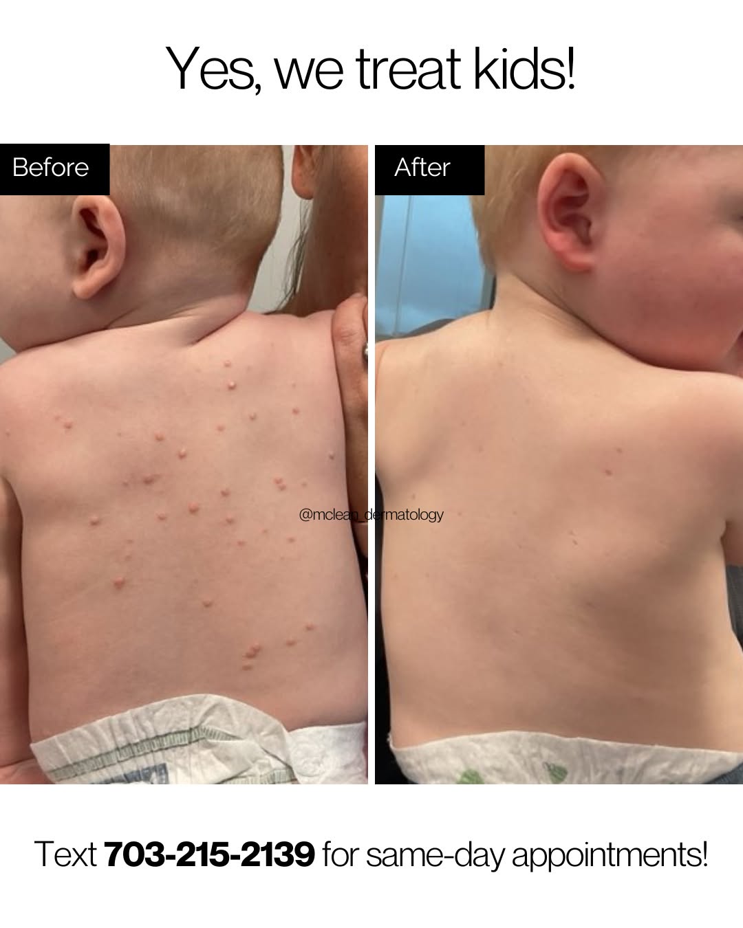 Instagram post by Dr. Lily Talakoub: Molluscum? We’ve got you covered! ✅ We treat kids of all ages and offer same-day appointments for pediatric dermatology. Let’s get your kidd…
