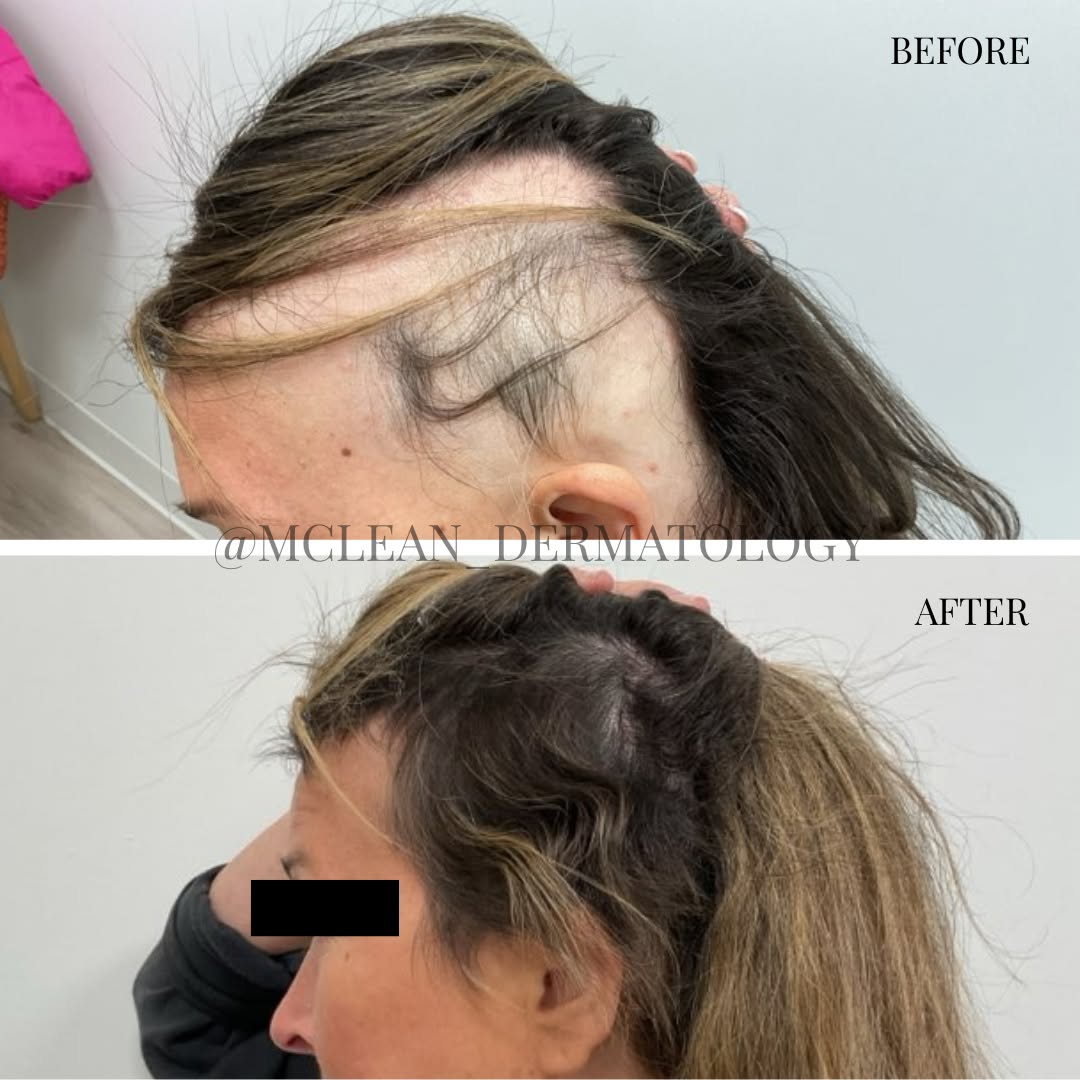 Instagram post by Dr. Lily Talakoub: Hair loss can be deeply emotional, but it's also treatable. This patient trusted us with her hair loss journey, and with a personalized plan…