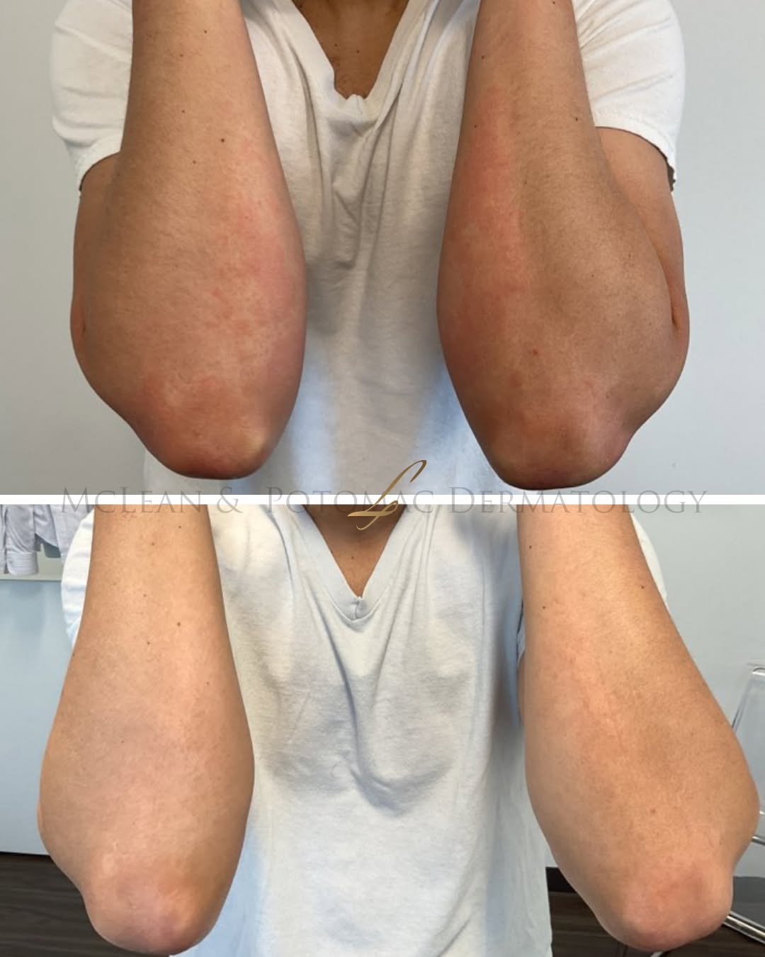 Instagram post by Dr. Lily Talakoub: Rash that won't go away? It could be contact dermatitis.⁠ ⁠ The common condition is caused by irritation or an allergic reaction to somethin…