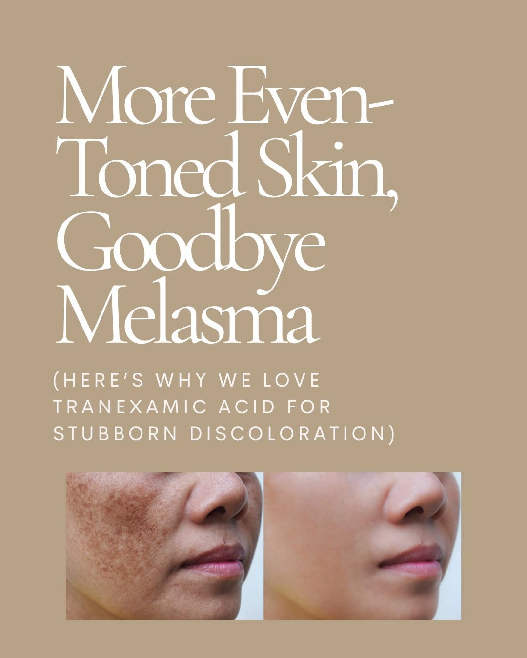 Instagram post by Dr. Lily Talakoub: If dark spots, uneven tone, or stubborn discoloration are getting in the way of your glow, tranexamic acid may be the skin-brightening suppo…