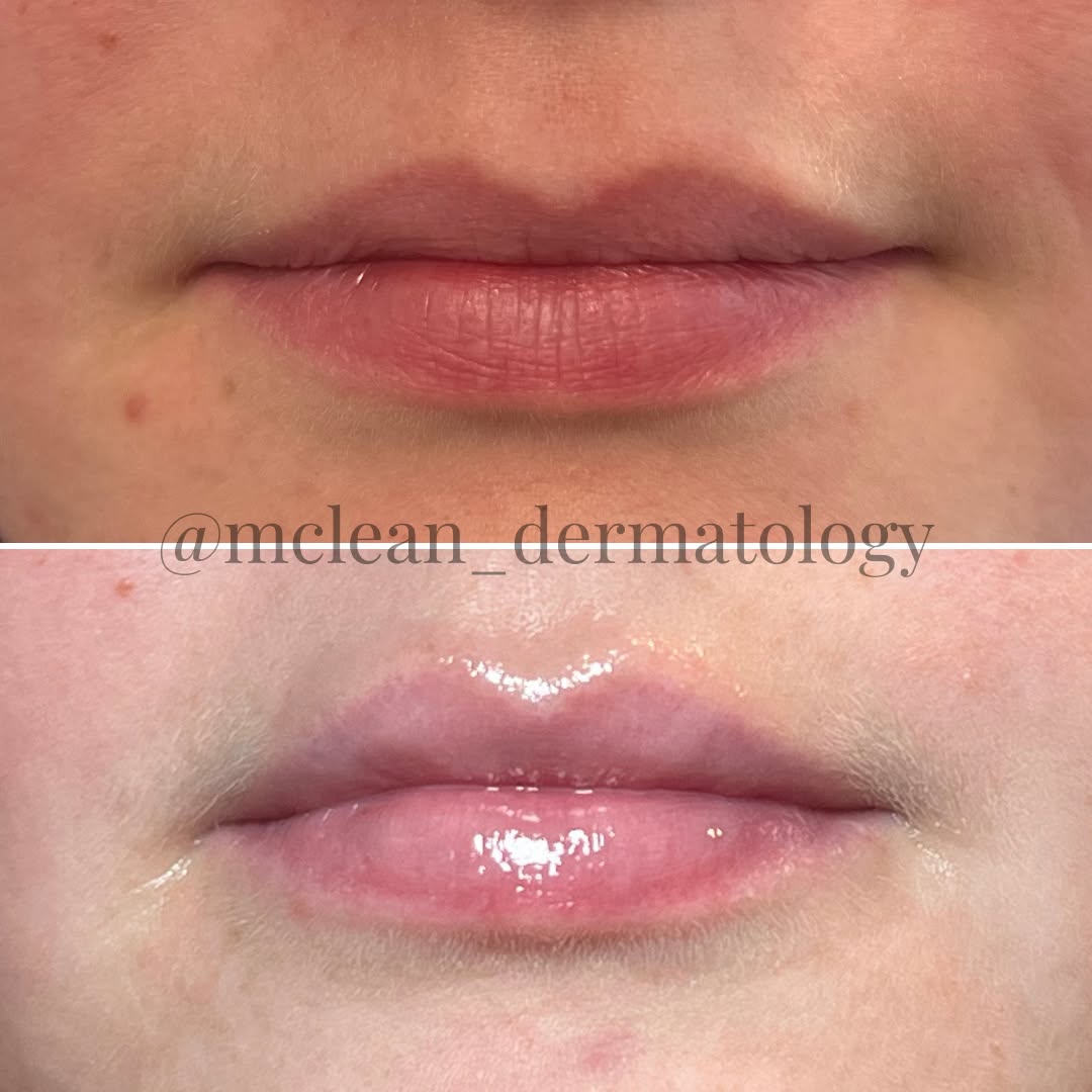 Instagram post by Dr. Lily Talakoub: 💋Subtle. Symmetrical. Natural ✨️⁠ This enhancement restored volume, defined shape, and maintained a soft, balanced look. ⁠ ⁠ Ready to enhan…