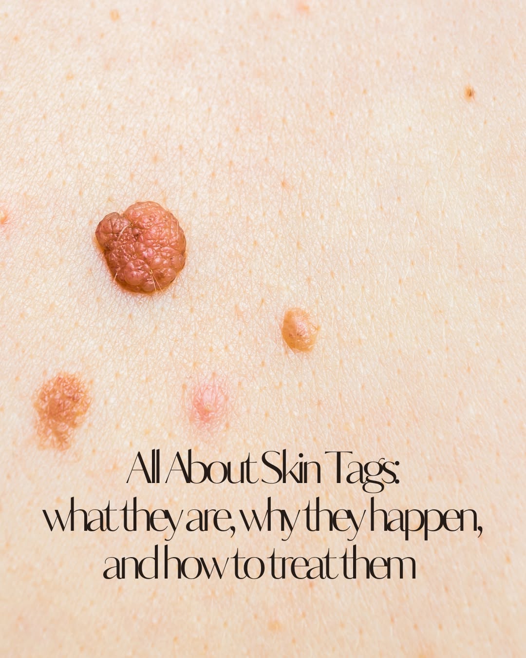 Instagram post by Dr. Lily Talakoub: Common. Benign. Easily treated. ⁠ Your guide to skin tags. What they are, why they appear, and expert removal options. ⁠ ⁠ Have a skin tag t…
