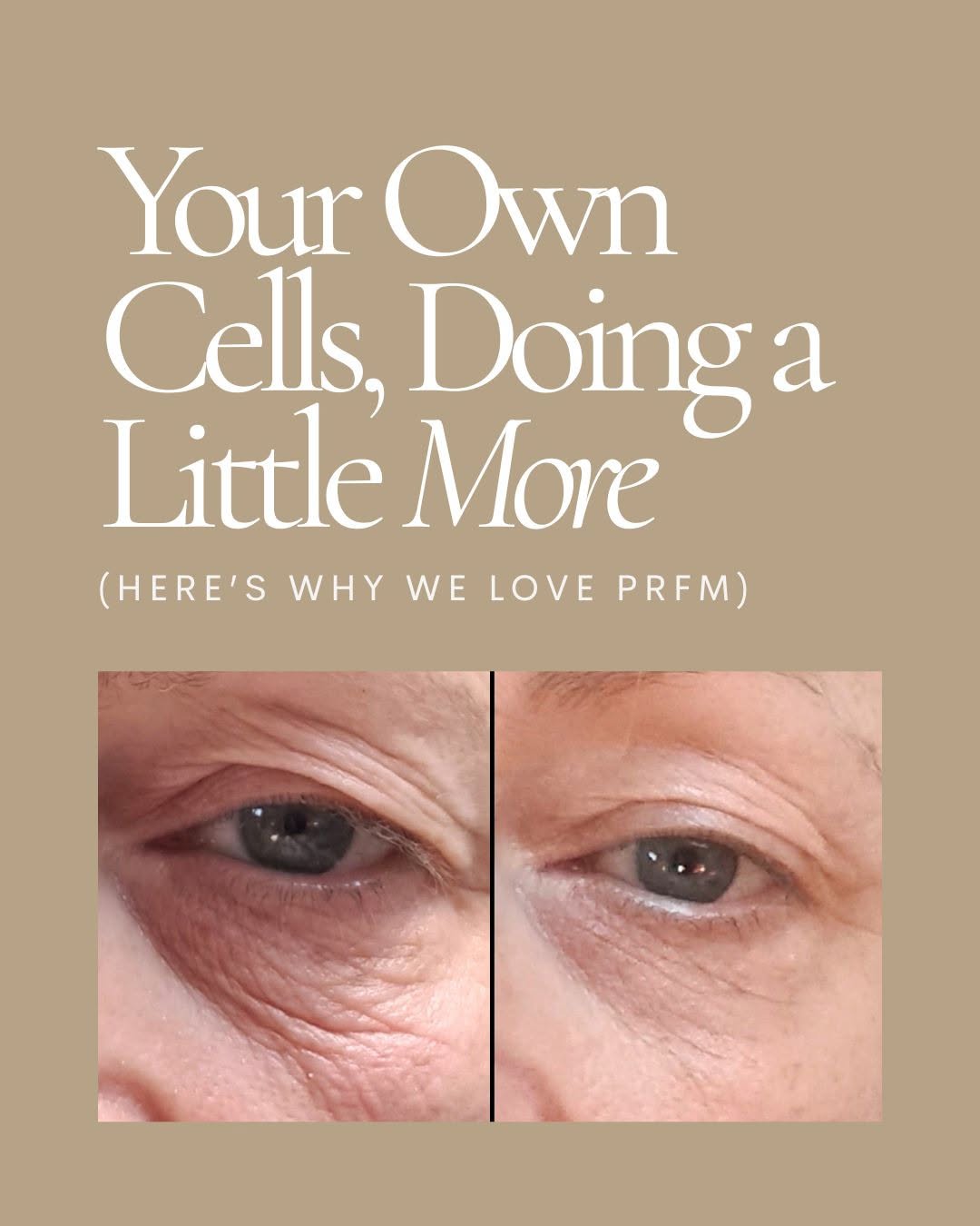 Instagram post by Dr. Lily Talakoub: Want a skin boost after microneedling? PRFM is a more supportive, blood-derived treatment designed for patients who want natural rejuvenatio…