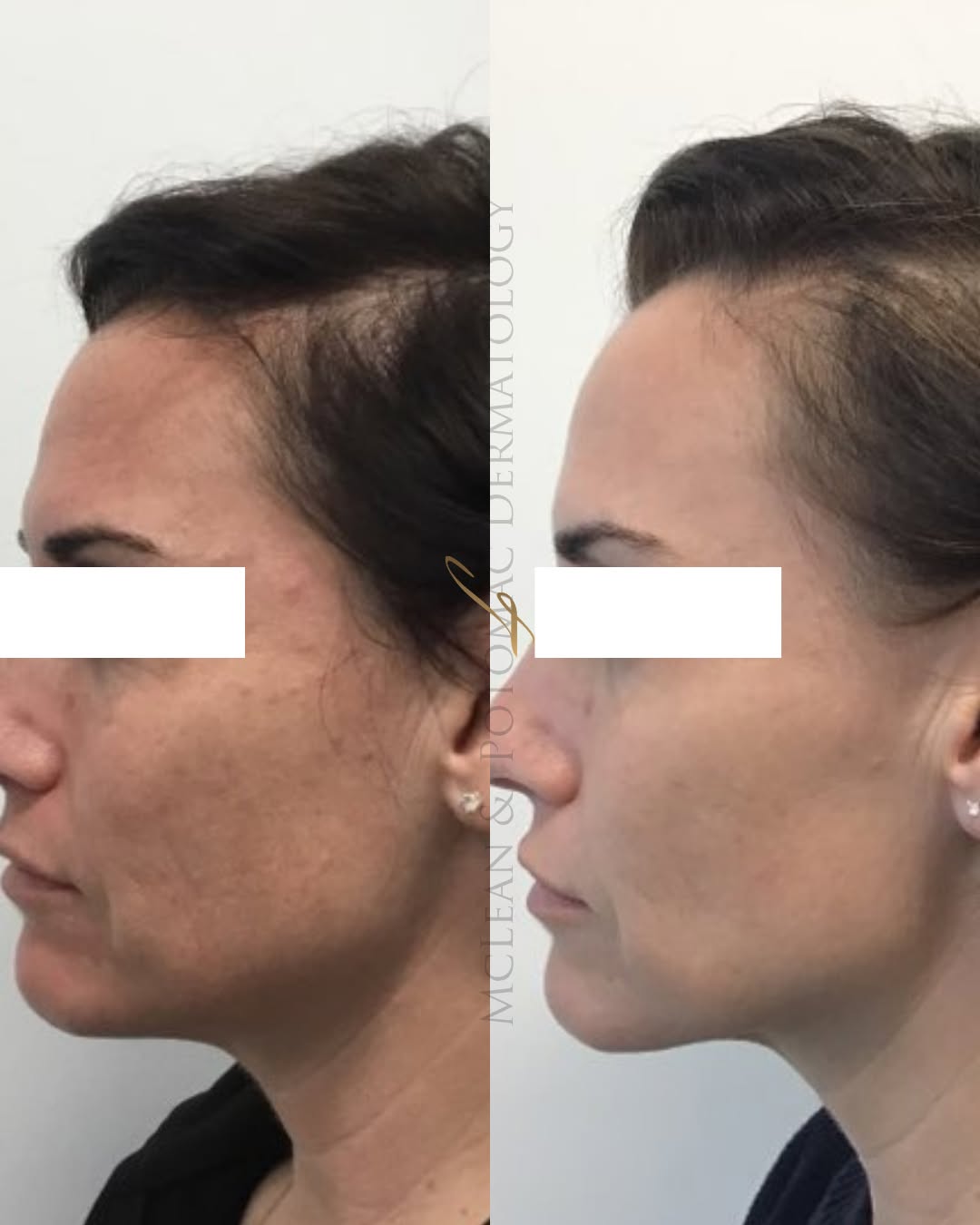 Instagram post by Dr. Lily Talakoub: Real skin, real results. ⁠ ⁠ Microneedling works by stimulating collagen to soften fine lines, refine pores, and improve uneven texture over…