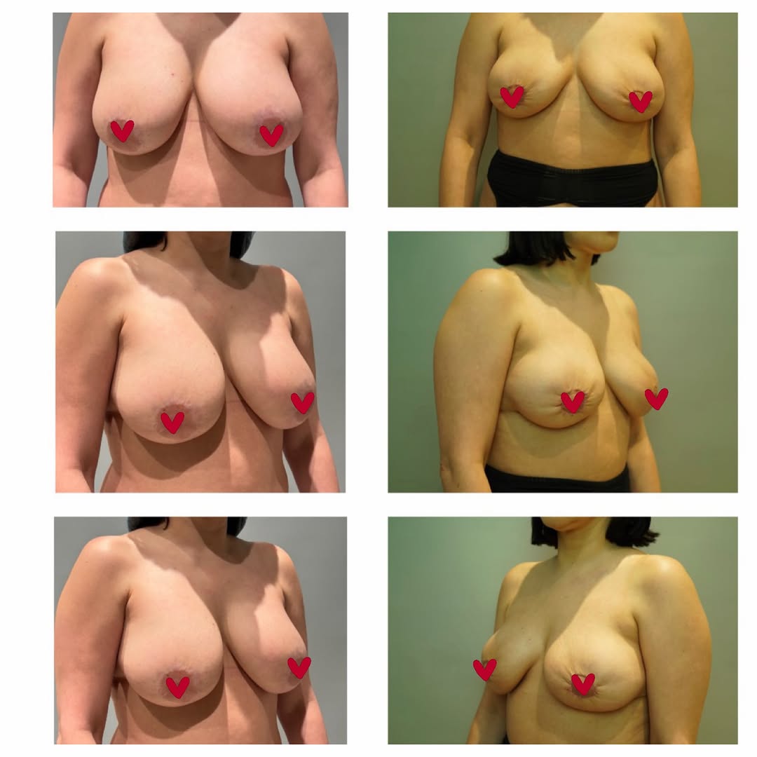 Instagram post by Dr. Linda Li: ....... 3 weeks post-op This patient underwent breast implant removal with a donut lift and is still very early in the healing process. At j…