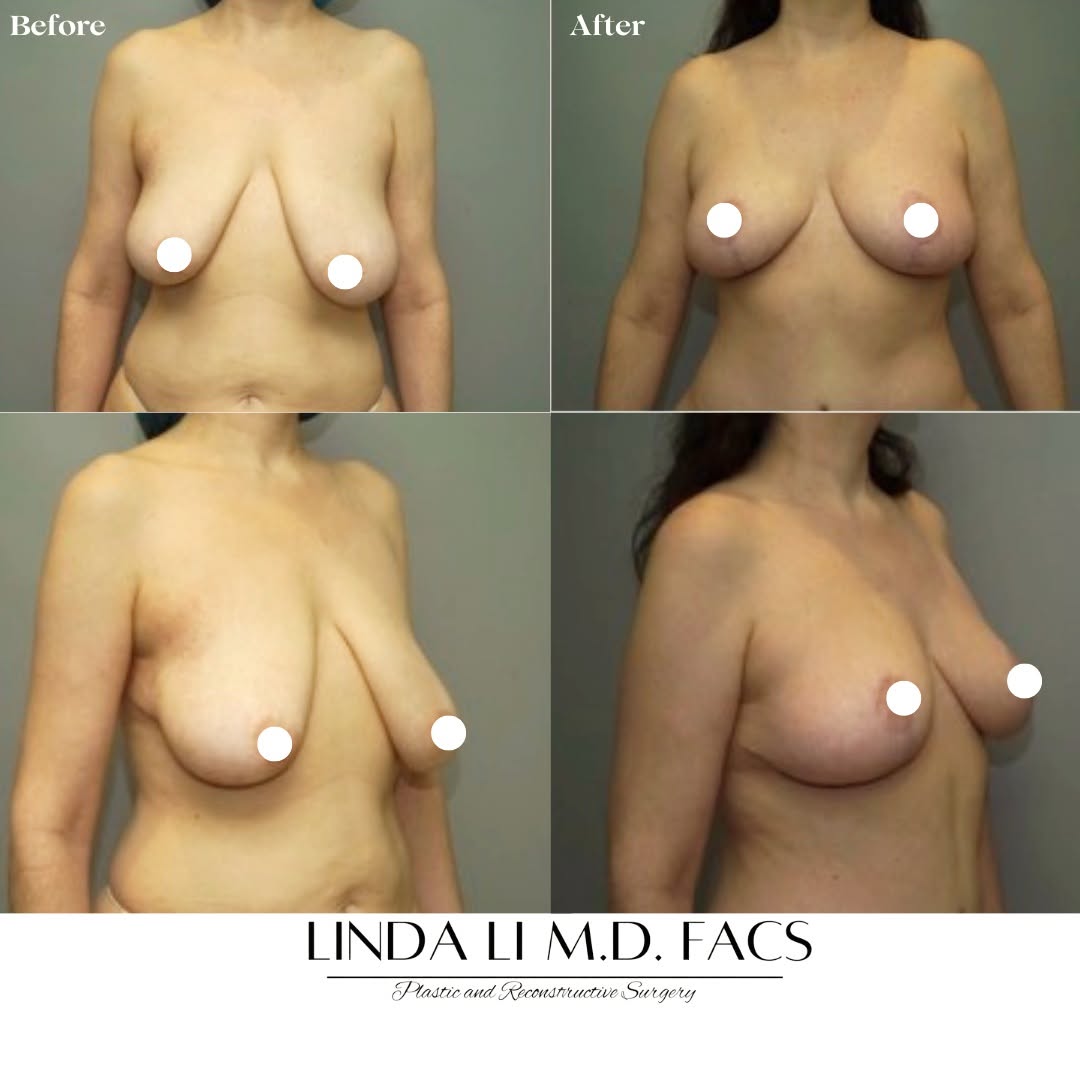 Instagram post by Dr. Linda Li: ✨ Mastopexy Before & After ✨ A beautifully lifted and reshaped breast contour through personalized surgical planning and meticulous techniqu…