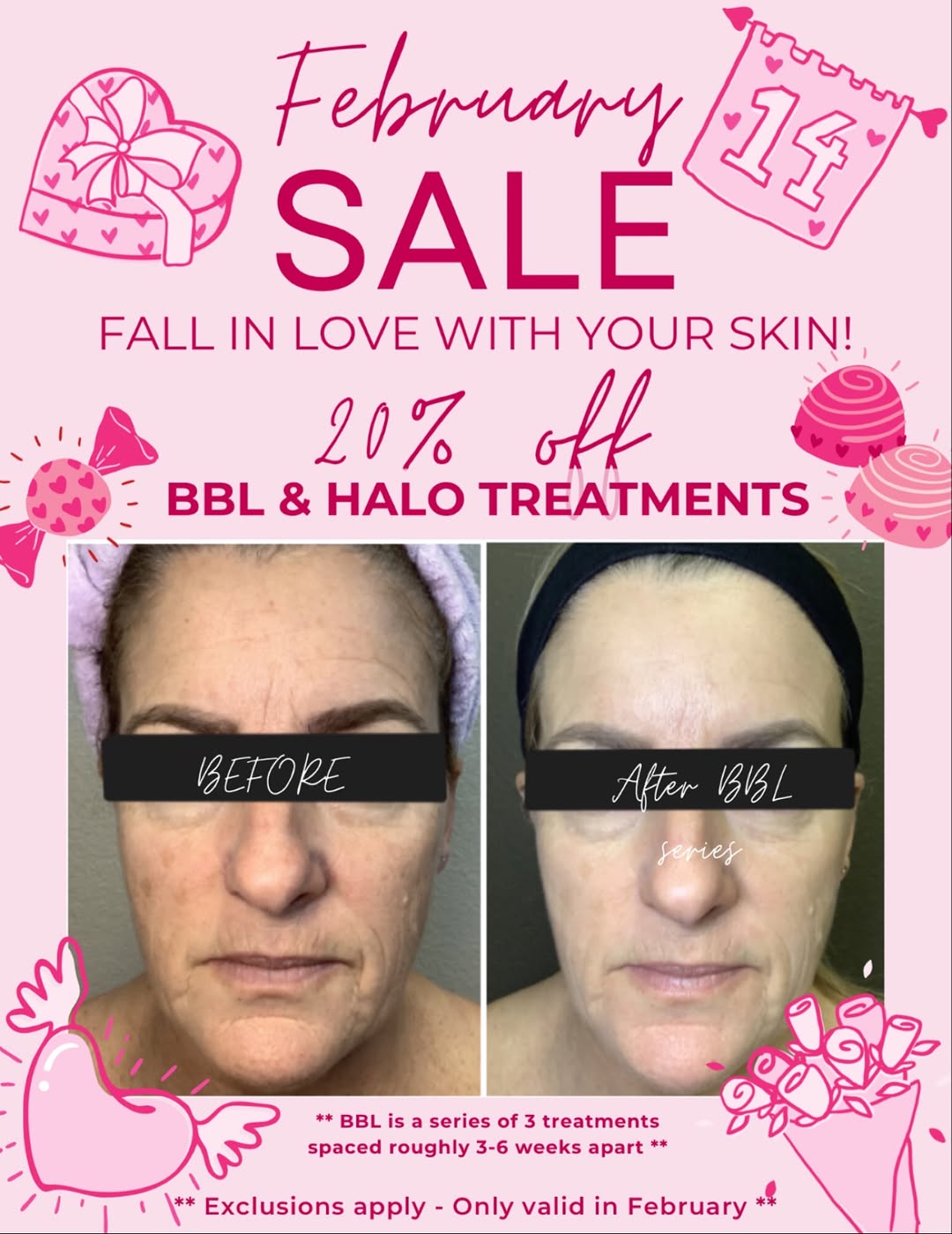 Instagram post by Dr. Lindie Borton: Valentine’s Day is right around the corner! Now is a great time to treat yourself to fresh, younger looking skin! Follow the link in our bio…