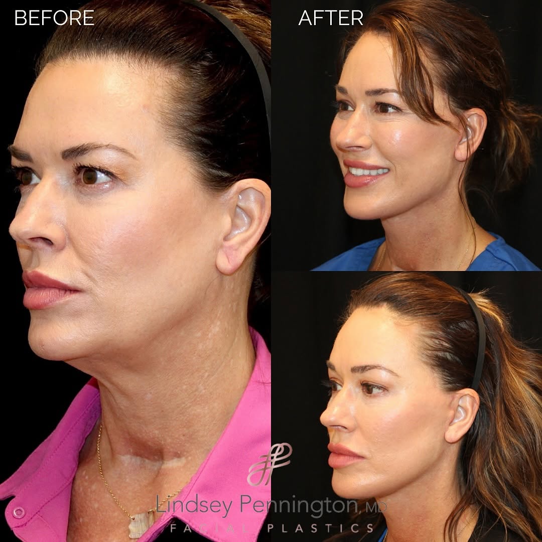 Instagram post by Dr. Lindsey Pennington: What you’ve all been waiting for… Lori’s BEFORE & AFTERS are here! ✨ It’s been just 4 weeks since Lori had her ✨ Endoscopic brow lift ✨ Exte…